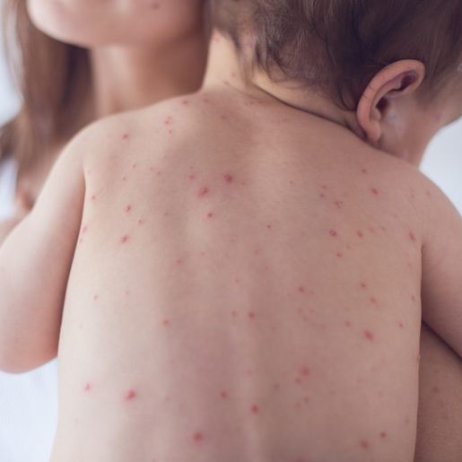 Surto de sarampo acende alerta da saúde de Itapiranga