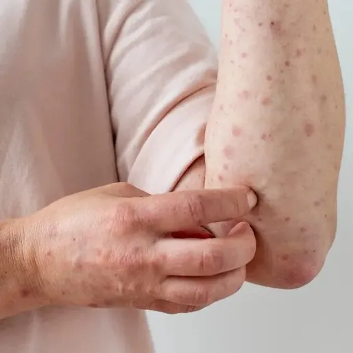 SC registra casos suspeitos de Mpox em quatro cidades e doença acende alerta