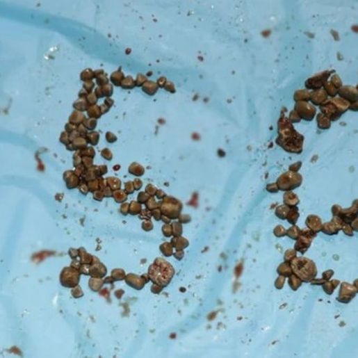 Médicos indianos removem 156 pedras nos rins de professor