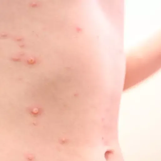 Segundo caso de varíola dos macacos é confirmado em Santa Catarina