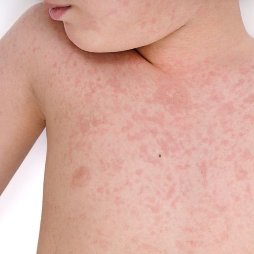 São Miguel do Oeste faz mutirão em empresas para vacinar contra sarampo