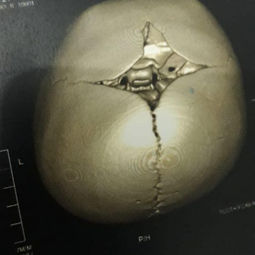 SMO: família pede ajuda para trigêmeos diagnosticados com assimetria craniana