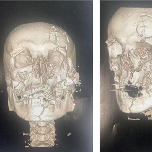 Polícia Civil de Cunha Porã conclui investigação de tentativa de homicídio