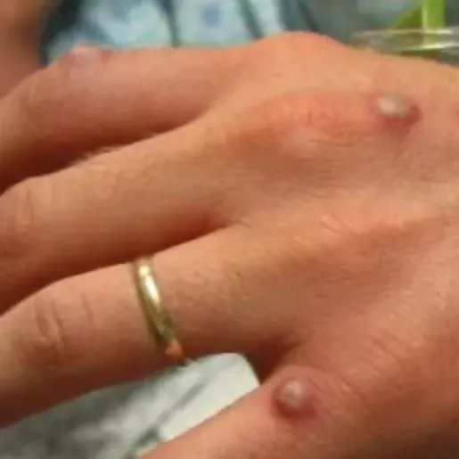 Paciente com suspeita de varíola dos macacos na região está ‘recuperada dos sintomas’