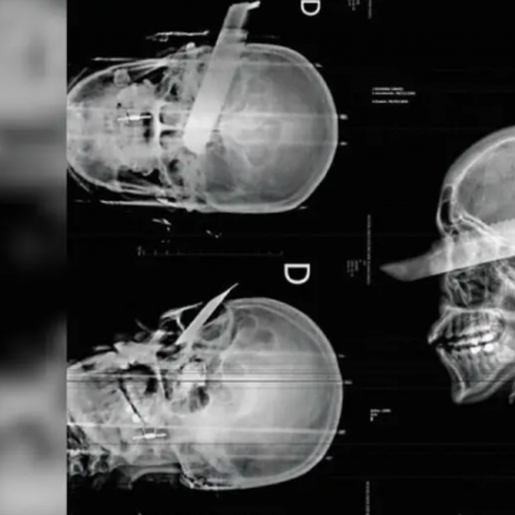 Mulher tem faca cravada no olho em tentativa de feminicídio em São Carlos