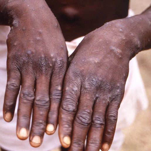 Brasil confirma sétimo caso de varíola dos macacos