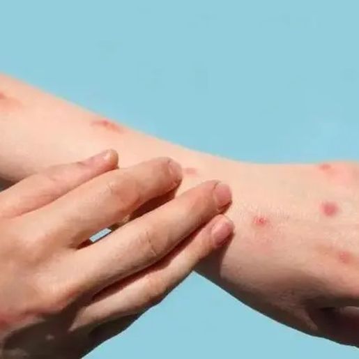 Brasil registra terceiro caso de varíola dos macacos