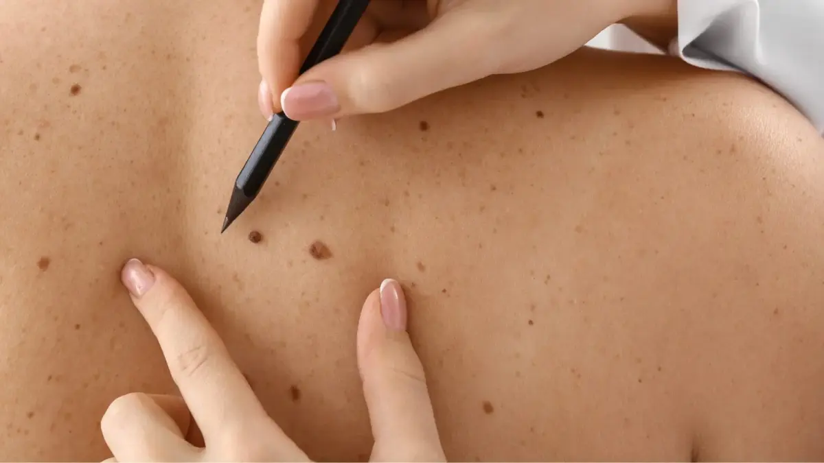 Santa Catarina lidera risco de câncer de pele no Sul do Brasil