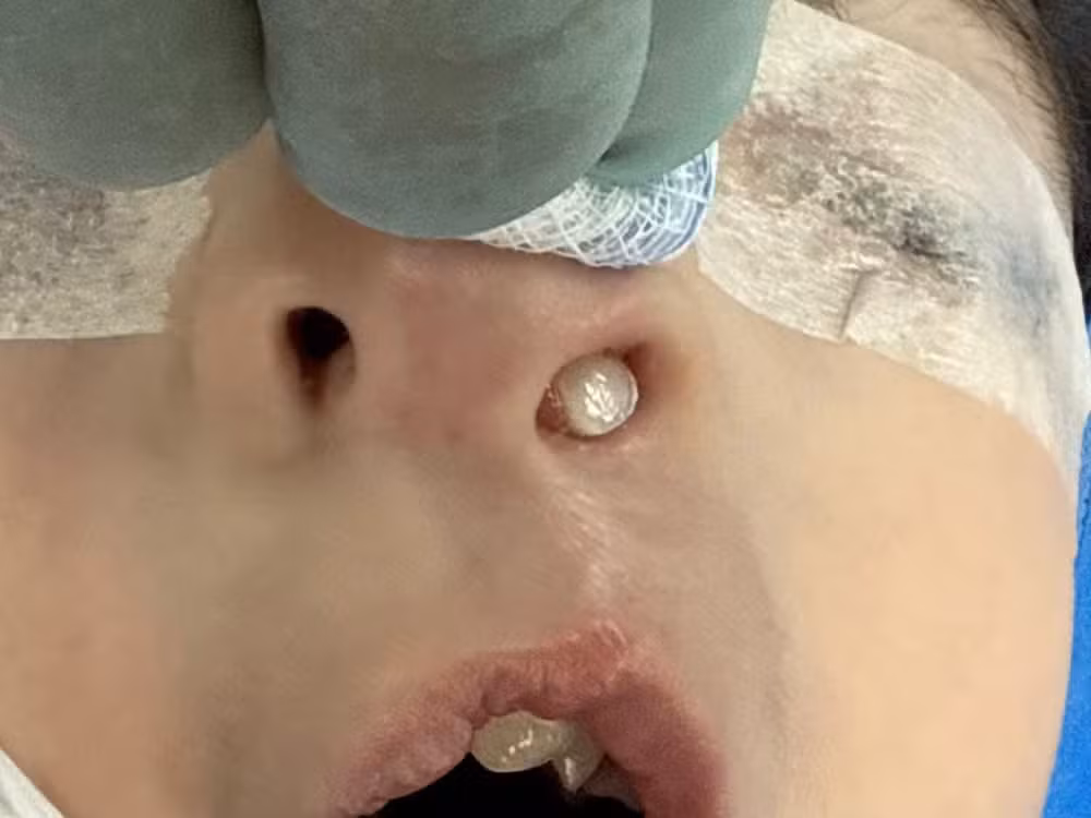 Dente nasce dentro do nariz de criança no Paraná