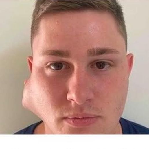 Morador de SJO busca apoio para realizar remoção de tumor no rosto