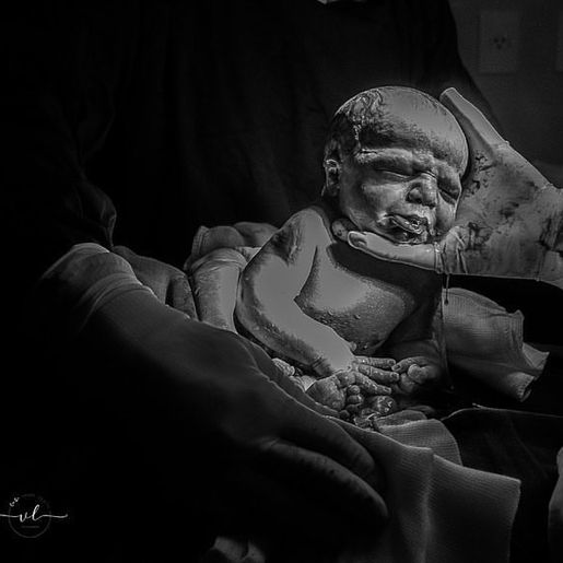 Parto raro realizado por obstetra em São Miguel do Oeste chama atenção nas redes sociais