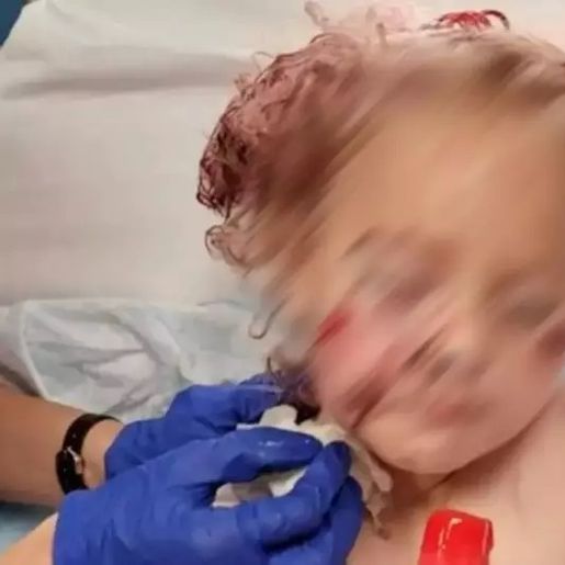 Criança de 5 anos é brutalmente atacada por cachorro e leva 50 pontos no rosto