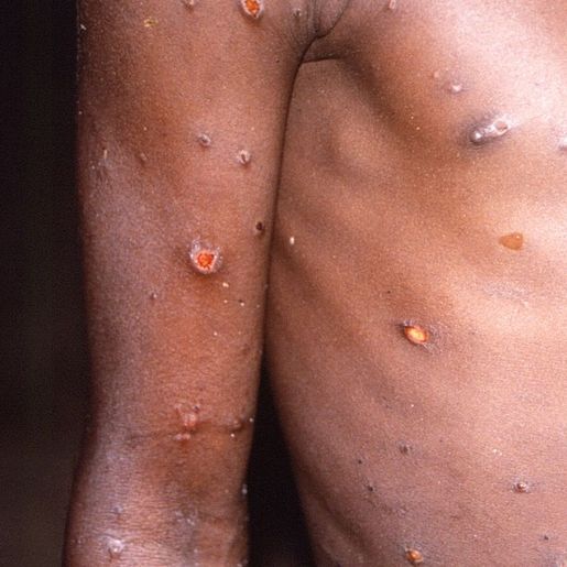 Brasil registra primeiros casos de transmissão comunitária da varíola dos macacos