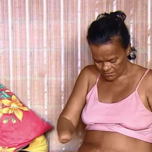 Mulher sem mãos e pernas tem pedido de benefício negado por não poder assinar papel