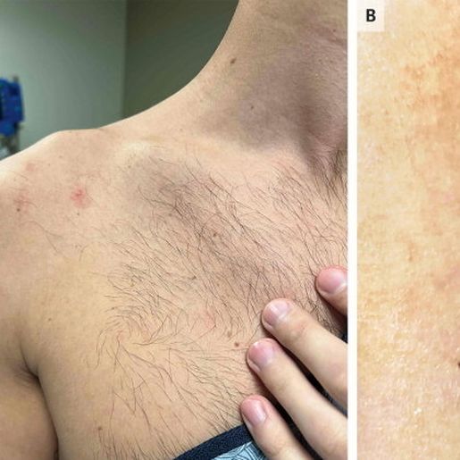 OMS admite que varíola do macaco pode ser transmitida sexualmente