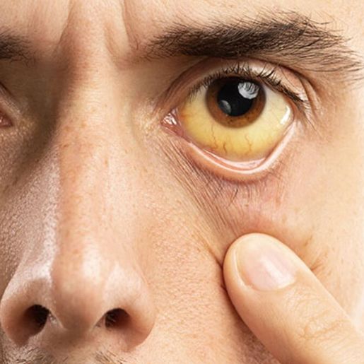 SC registrou mais de 26 mil casos de hepatites virais em 10 anos