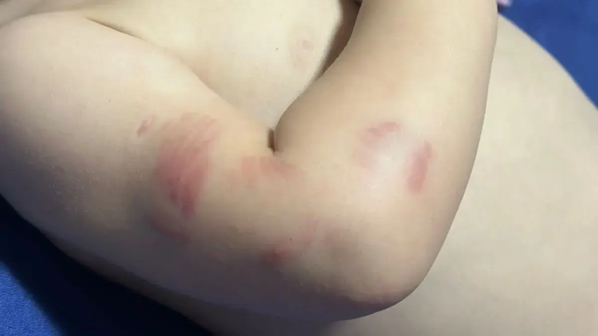 Bebê de 11 meses é transferida após voltar de creche cheia de mordidas em Itajaí