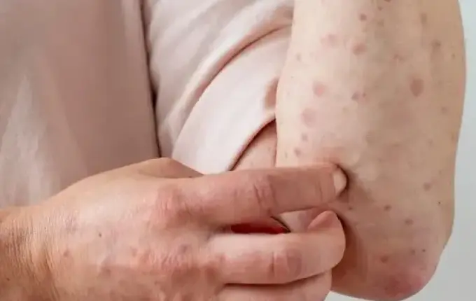 SC registra casos suspeitos de Mpox em quatro cidades e doença acende alerta