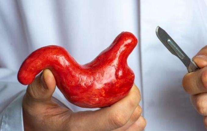 Com novas regras para cirurgia bariátrica, SC tem mais de 400 pessoas na fila do SUS