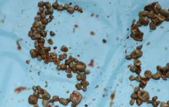 Médicos indianos removem 156 pedras nos rins de professor