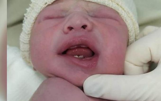 Bebê nasce com dois dentes e surpreende família em Francisco Beltrão