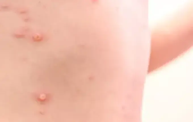 Segundo caso de varíola dos macacos é confirmado em Santa Catarina