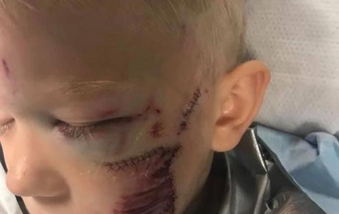 Menino salva a irmã de ataque de cachorro e fica com rosto desfigurado