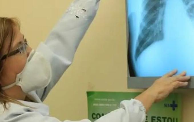 Extremo Oeste registra 26 casos de tuberculose em 2024, superando total de 2023