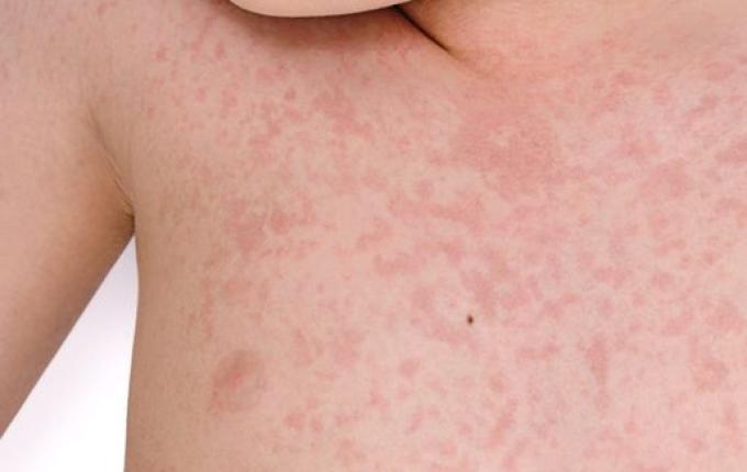 São Miguel do Oeste faz mutirão em empresas para vacinar contra sarampo