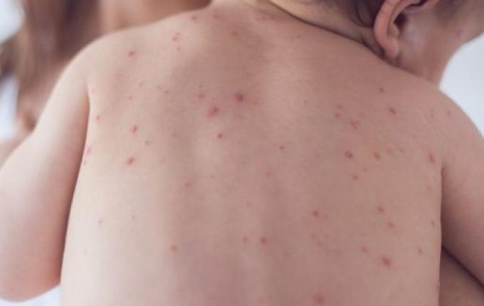 Extremo Oeste recebe reforço na vacinação com Dose Zero contra o sarampo para bebês