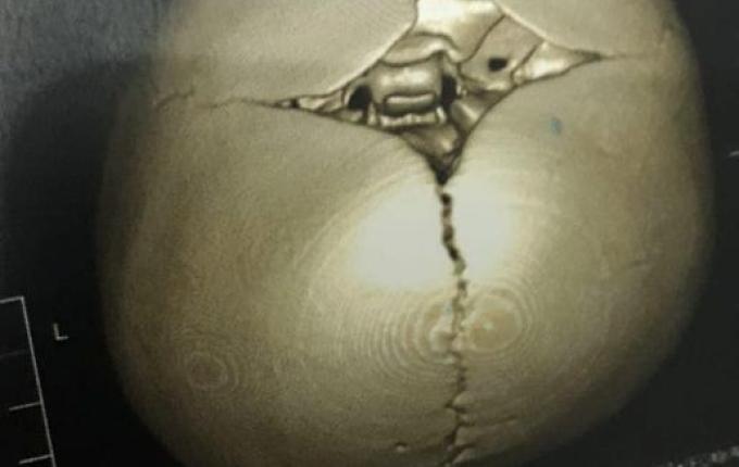 SMO: família pede ajuda para trigêmeos diagnosticados com assimetria craniana