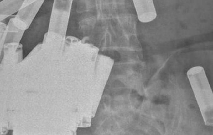 Mulher com 55 pilhas dentro do corpo deixa médicos chocados: 'Maior quantidade engolida'