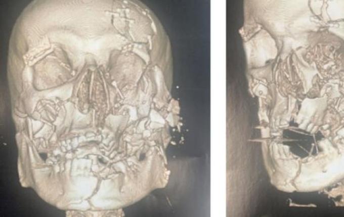 Polícia Civil de Cunha Porã conclui investigação de tentativa de homicídio