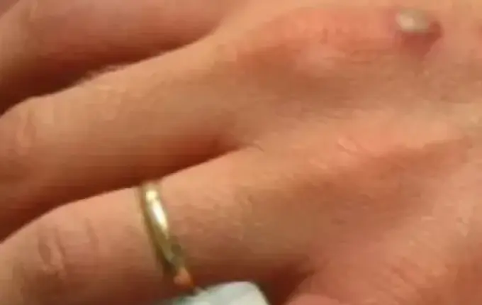 Paciente com suspeita de varíola dos macacos na região está ‘recuperada dos sintomas’