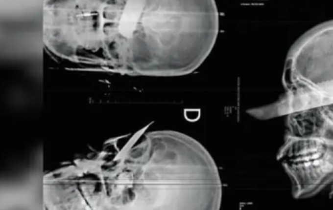 Mulher tem faca cravada no olho em tentativa de feminicídio em São Carlos