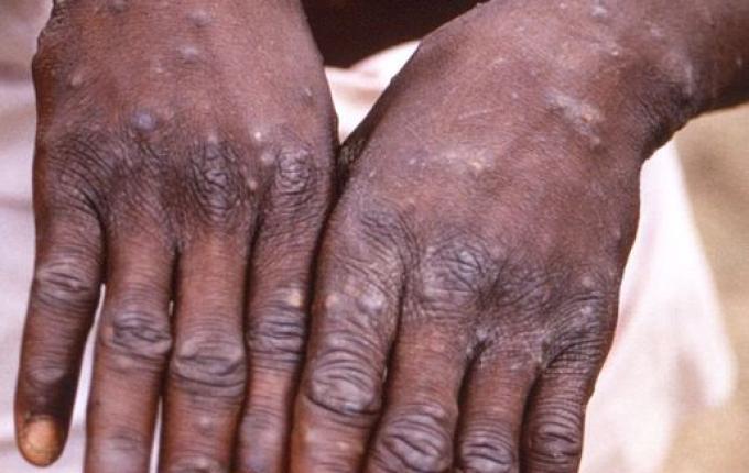 Brasil confirma sétimo caso de varíola dos macacos