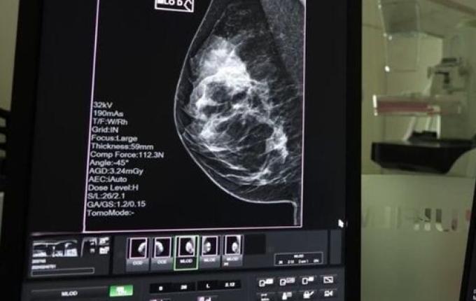 SC realiza mutirão de mamografias com prioridade para pacientes na fila de espera