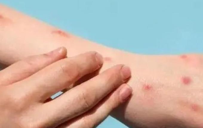 Brasil registra terceiro caso de varíola dos macacos