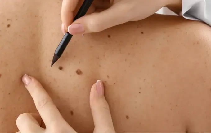 Santa Catarina lidera risco de câncer de pele no Sul do Brasil