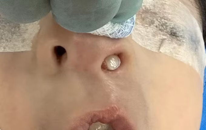 Dente nasce dentro do nariz de criança no Paraná