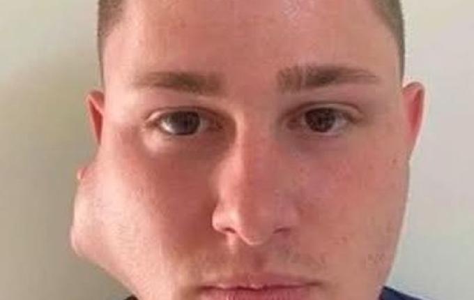 Morador de SJO busca apoio para realizar remoção de tumor no rosto