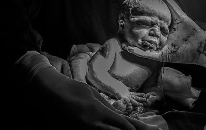 Parto raro realizado por obstetra em São Miguel do Oeste chama atenção nas redes sociais