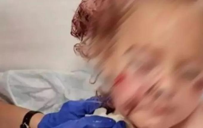 Criança de 5 anos é brutalmente atacada por cachorro e leva 50 pontos no rosto