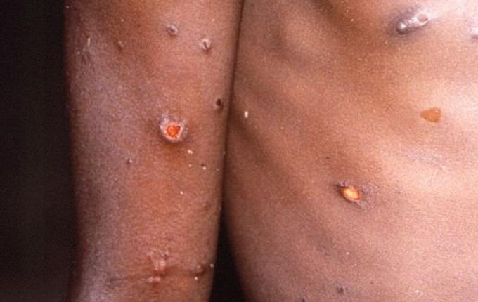 Brasil registra primeiros casos de transmissão comunitária da varíola dos macacos