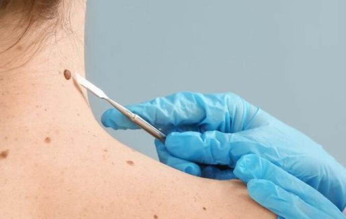 Câncer de pele matou 302 pessoas em SC em 2024, aponta Secretaria de Saúde