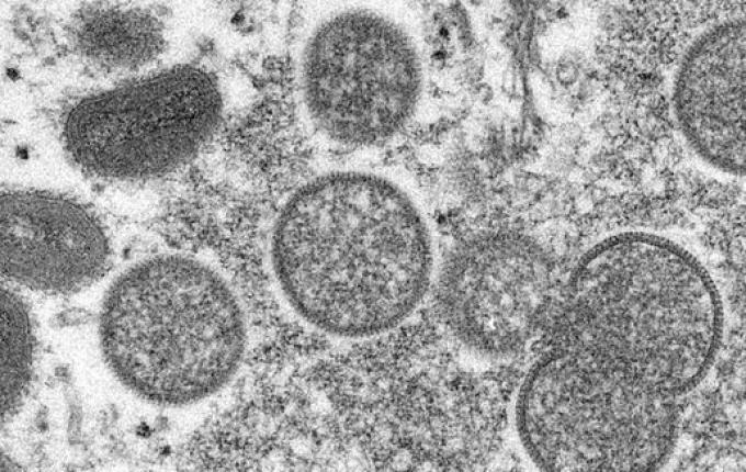 Brasil já registra mais de 200 casos confirmados de varíola dos macacos