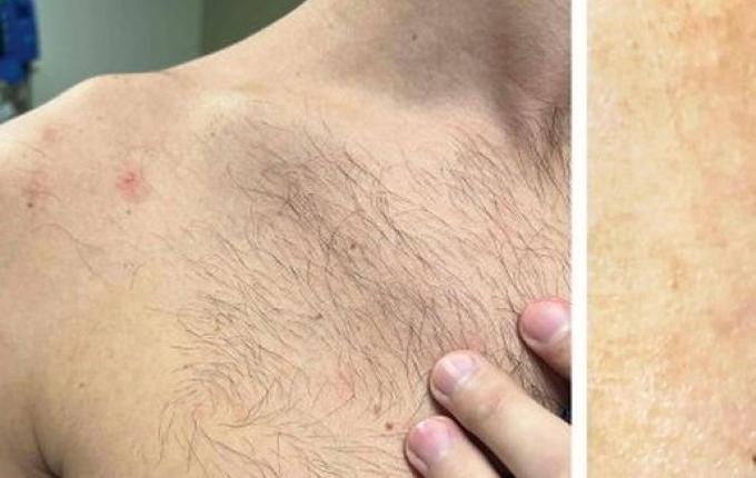 OMS admite que varíola do macaco pode ser transmitida sexualmente