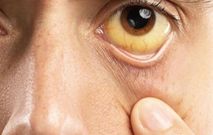 SC registrou mais de 26 mil casos de hepatites virais em 10 anos