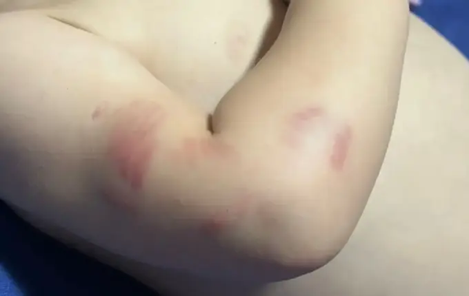 Bebê de 11 meses é transferida após voltar de creche cheia de mordidas em Itajaí