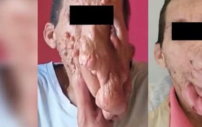 Cirurgia retira 700g de tumores do rosto de homem com doença rara em SC